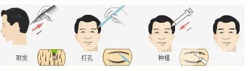 植眉毛價格大揭秘，自信的力量與價格變化解析